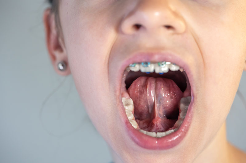 Podcinanie wędzidełek - zdjęcie podglądowe pokazujące wnętrze jamy ustnej pacjenta