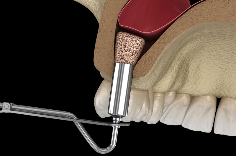 Zdjęcie pokazujące podgląd chirurgicznego podnoszenia dna zatoki.