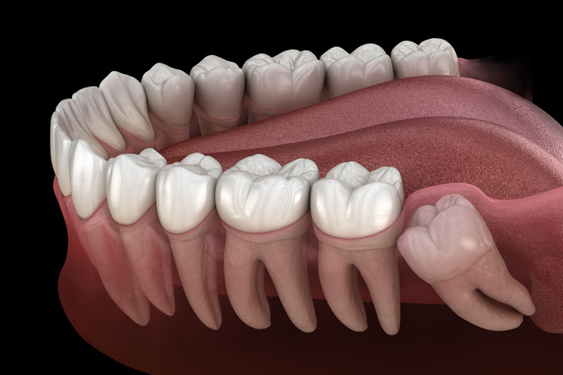 Obraz przedstawia krzywo rosnącego zęba, którega da się usunąć tylko metodąchirurgiczną